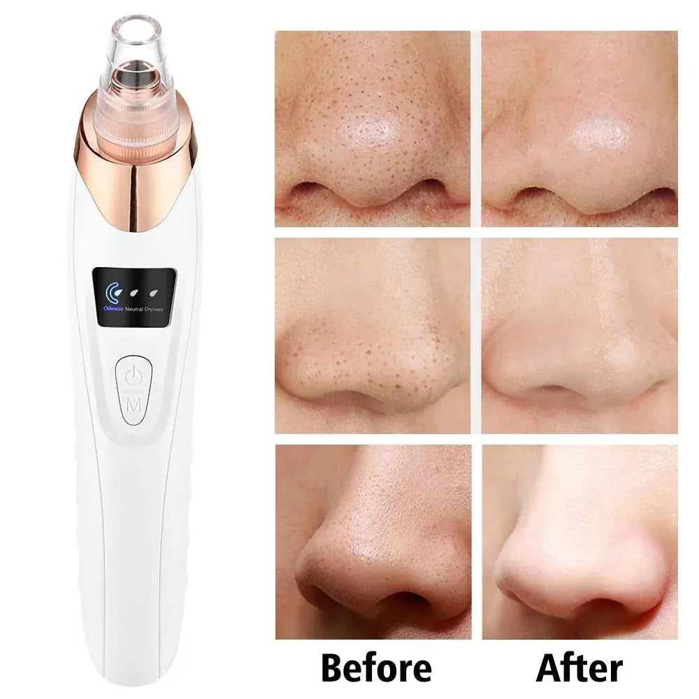 BLACK HEADS ACNE OIL REMOVER 5 in 1 Glamour Store